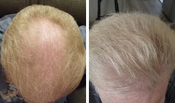 Lee before and after