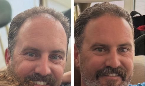 Ryer before and after