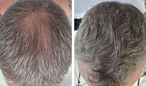 Travis before and after