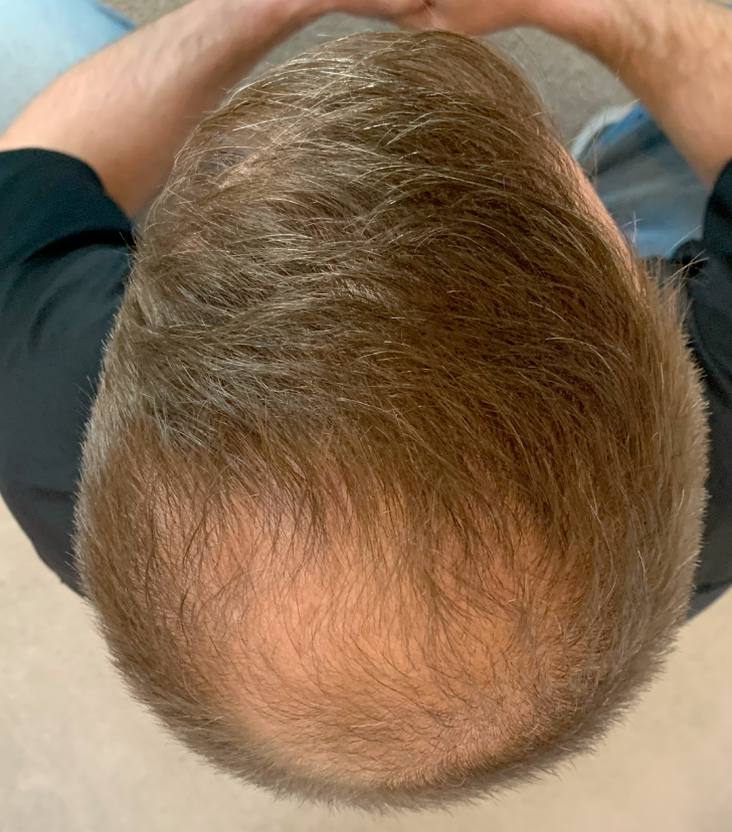 Crown before Locklab treatment
