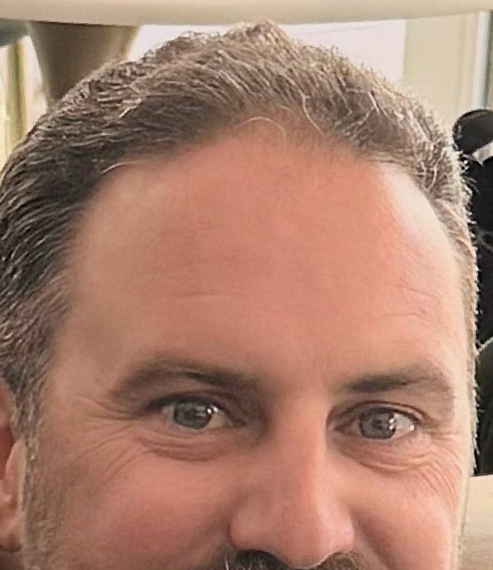 Hairline after Locklab treatment