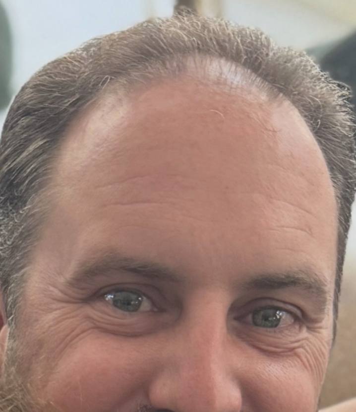 Hairline before Locklab treatment