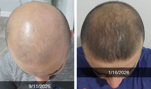 Esam before and after