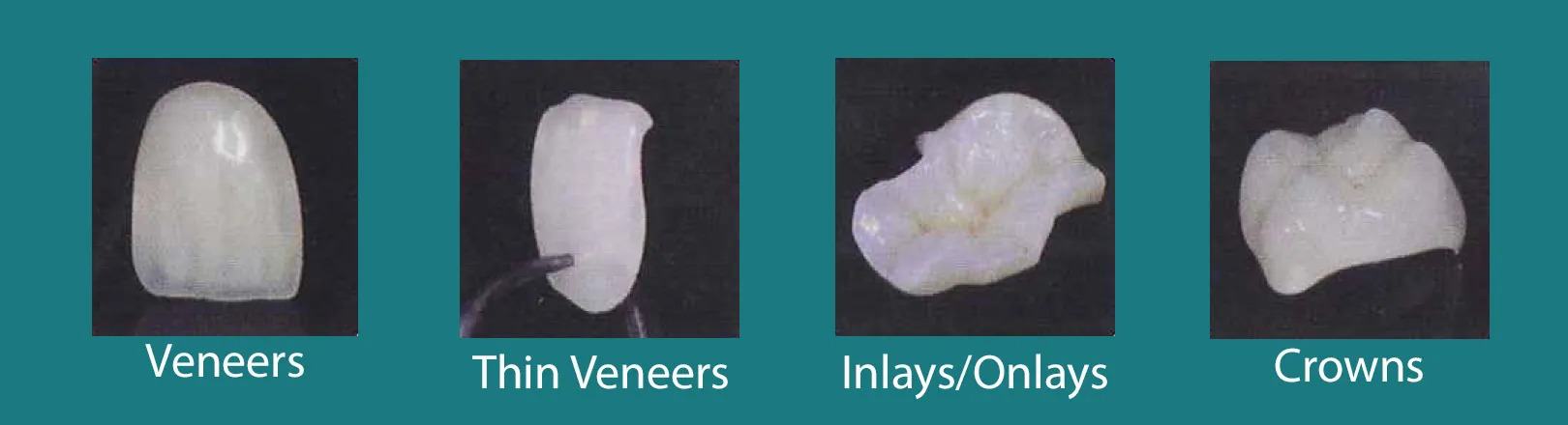 Ceramic Dental Restorations