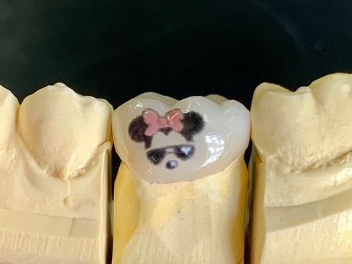 Tooth Tattoos in Cosmetic Dentistry