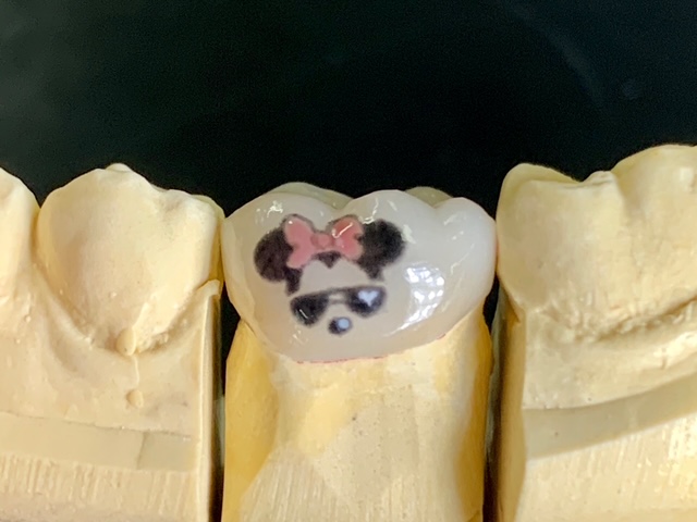 Tooth Tattoos in Cosmetic Dentistry