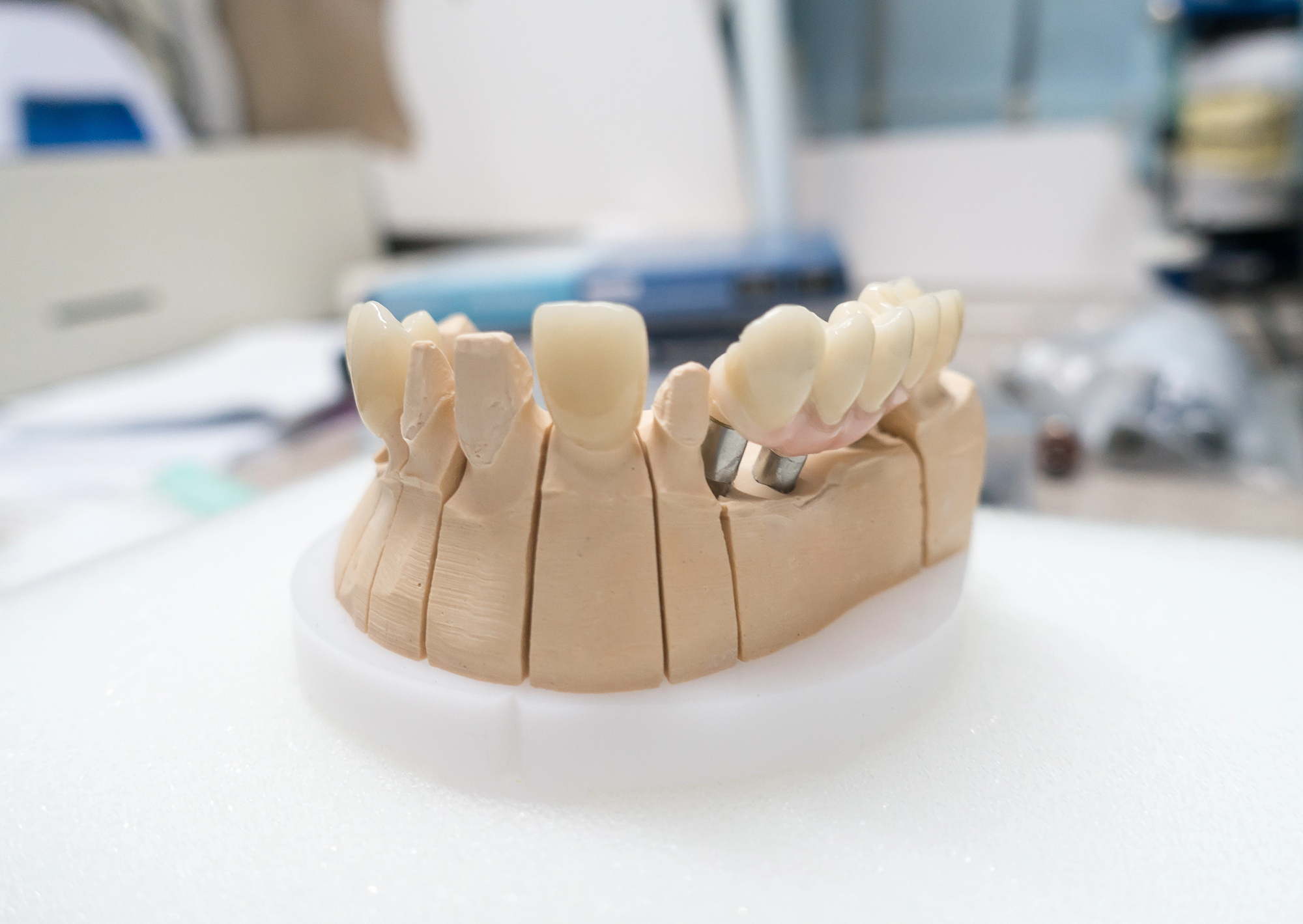 Same-Day CEREC Crowns in Tigard
