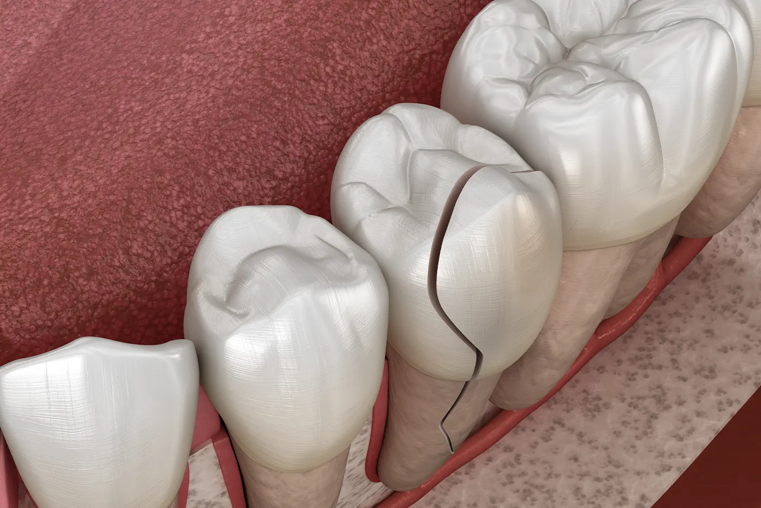 Chipped or Broken Tooth: Is It a Dental Emergency?