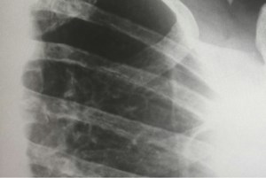 Staff shortage disrupts X-ray, ECG services in Nipawin