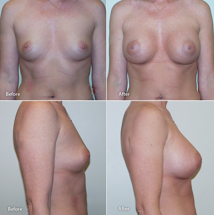 Breast Augmentation Before and After Large Photo #11