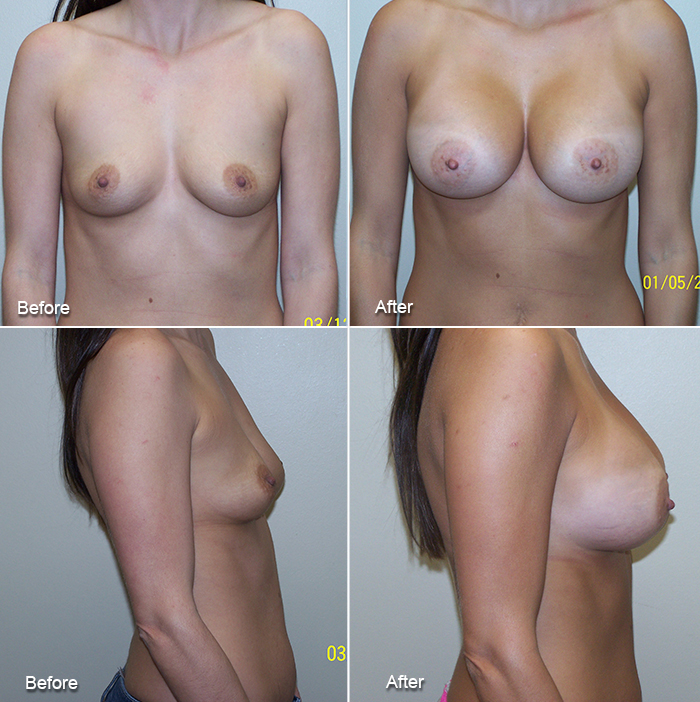 5'3' 100 pounds cup B to D 360cc MP