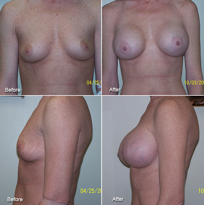 Breast Augmentation Before and After #11
