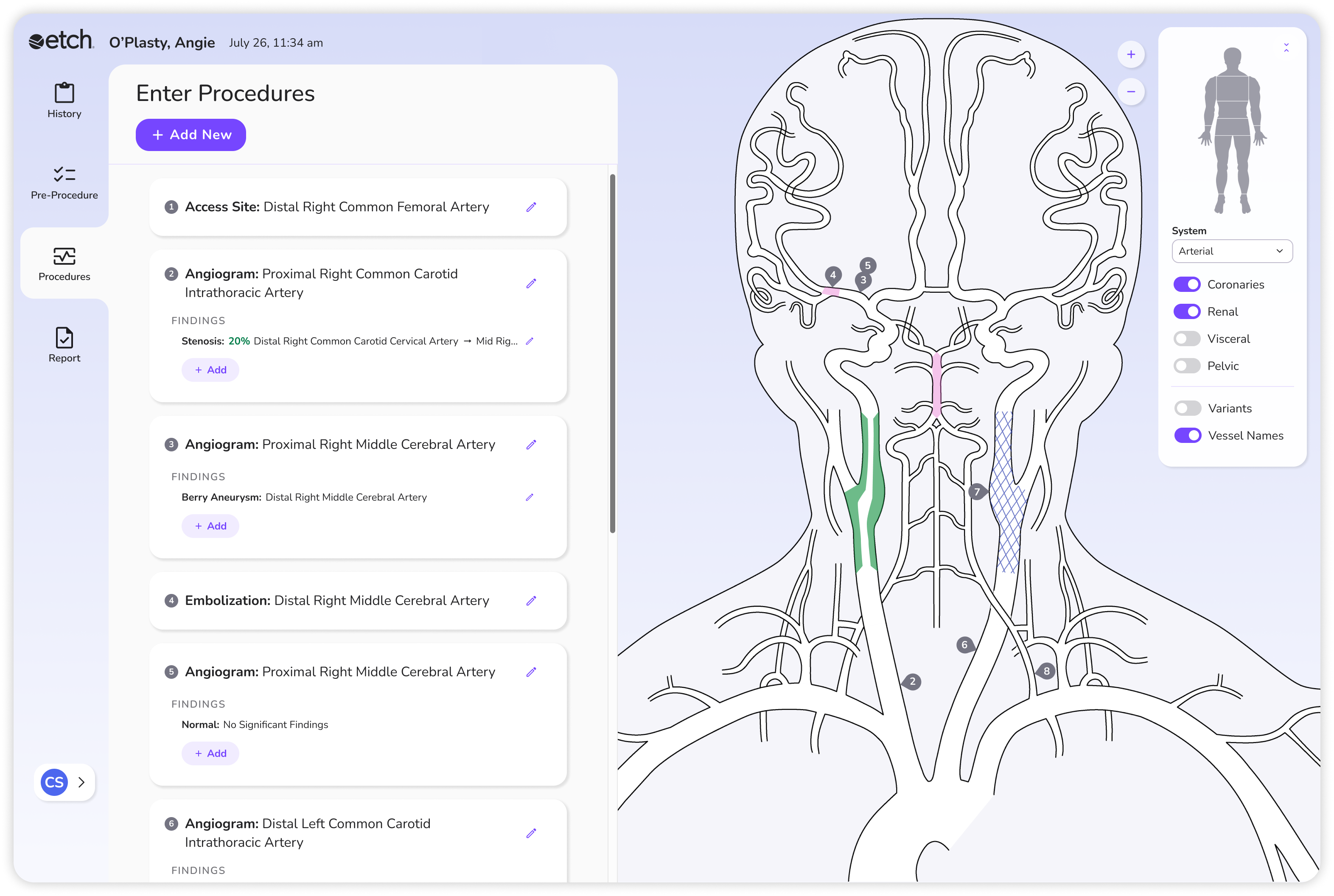 Image of ZHealth Documentation Etch User Interface on a computer screen displaying a Cerebral-Embolization case and procedure