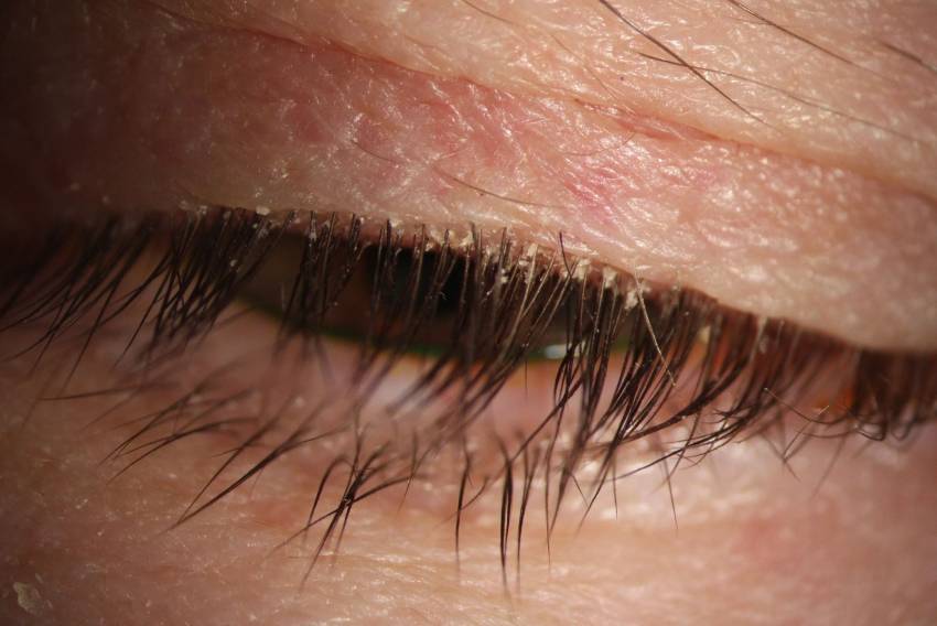 Clinical close-up showing flaky debris around the eyelashes caused by anterior blepharitis
