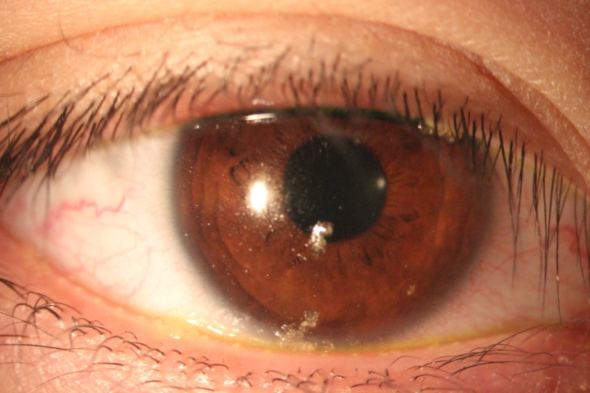 Clinical close-up of an eye showing thickened meibomian gland oil along the eyelid margin