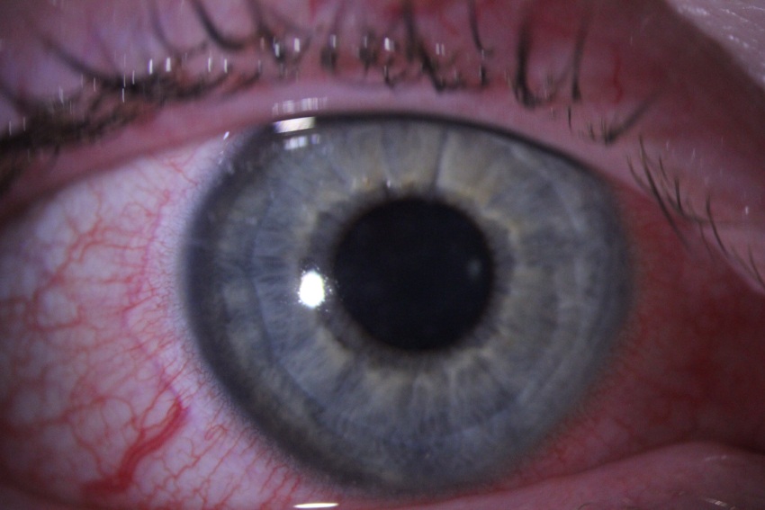 Clinical close-up of a red and inflamed eye caused by viral conjunctivitis