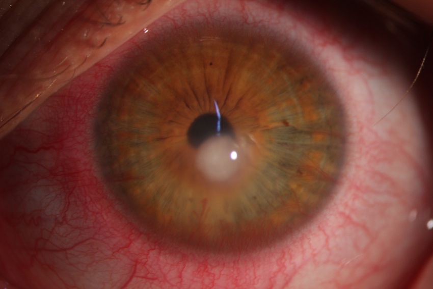 Clinical close-up of a severely red eye caused by acute anterior uveitis