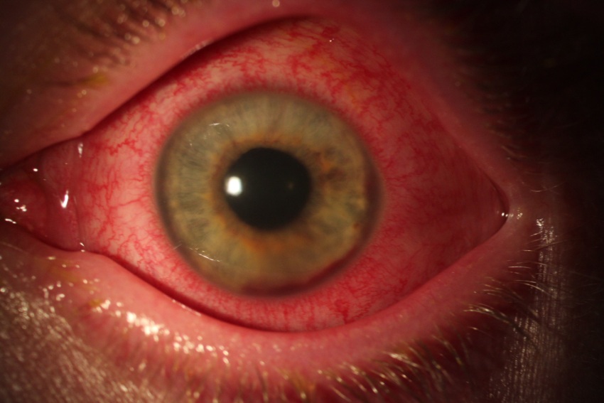 Clinical close-up of a severely red eye caused by acute anterior uveitis