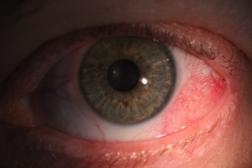 Clinical close-up showing localised redness and inflammation caused by episcleritis