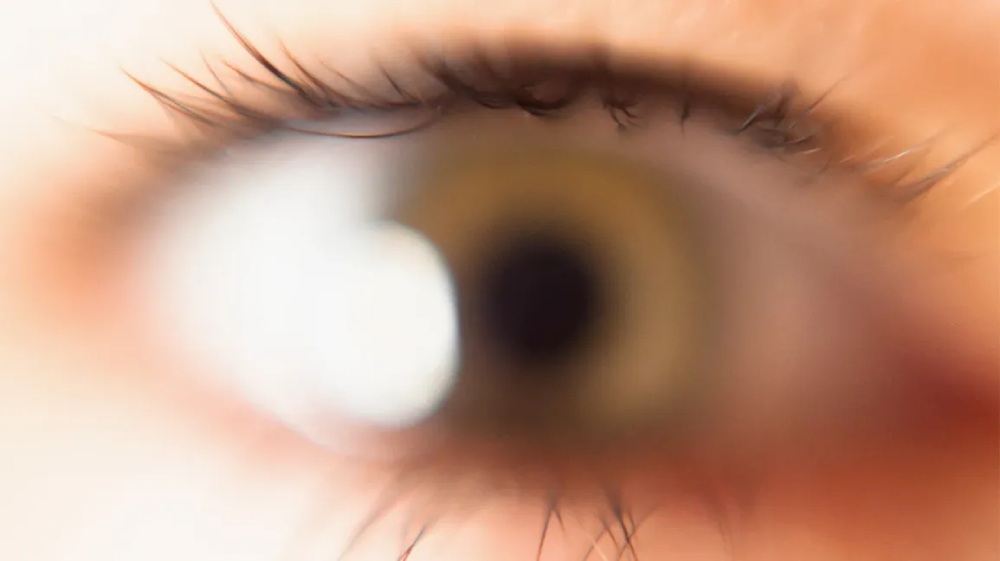 Close-up blurred view of an eye representing sudden blurred vision that may require urgent assessment