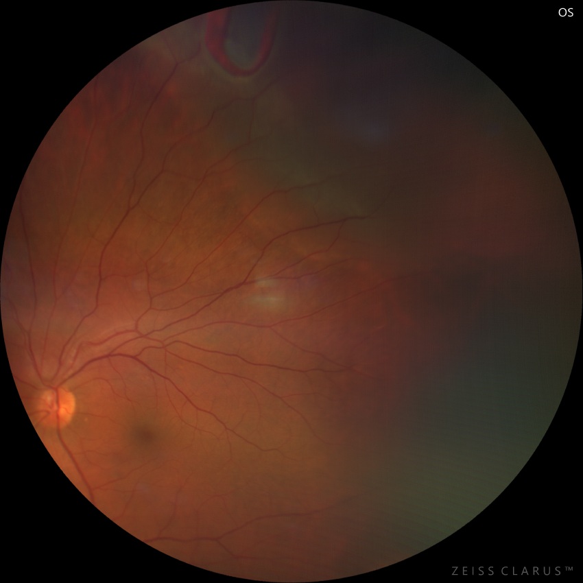Wide-field retinal image of the left eye showing a horseshoe retinal tear in the superior temporal retina