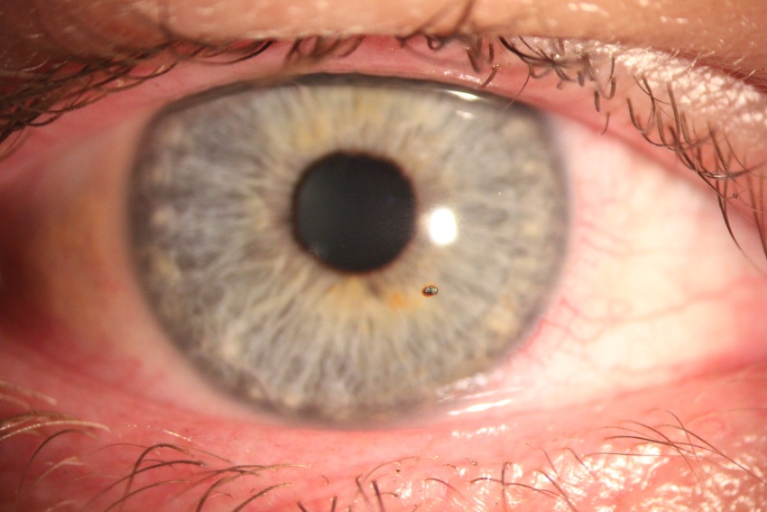 Clinical close-up of an eye with a small metallic foreign body embedded in the cornea