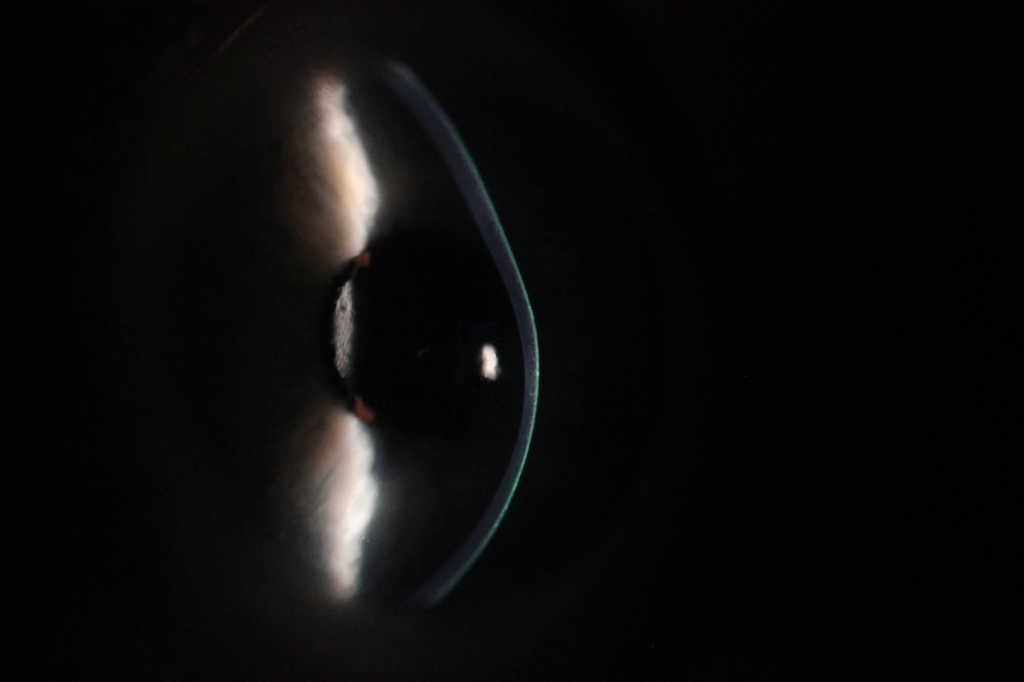 Side view slit lamp image showing advanced keratoconus with cone-shaped cornea