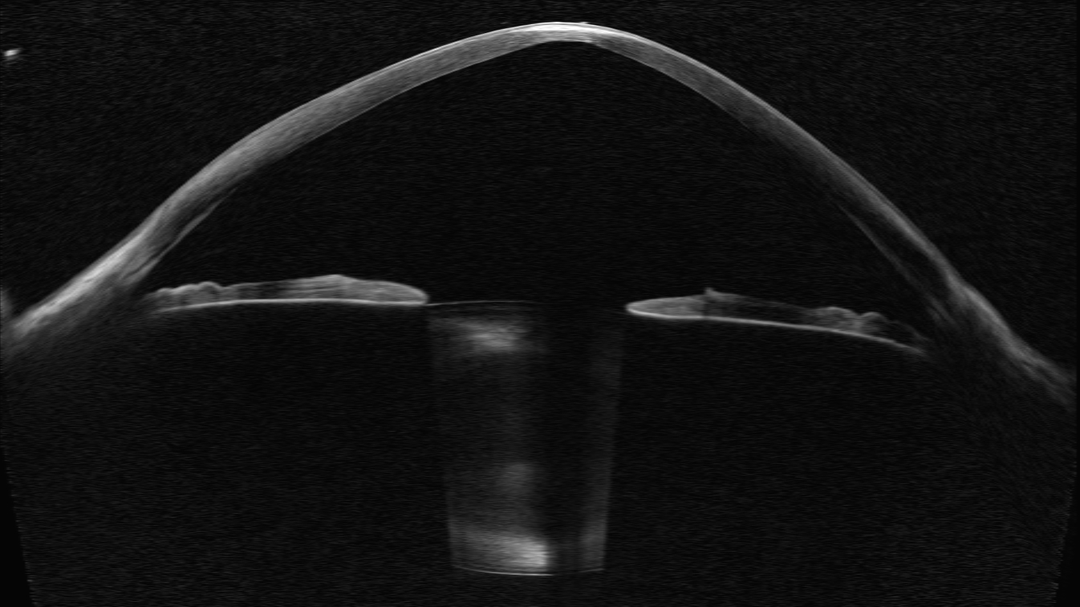 OCT scan showing advanced keratoconus and corneal thinning