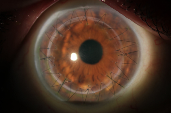 Corneal graft after keratoconus surgery in Adelaide