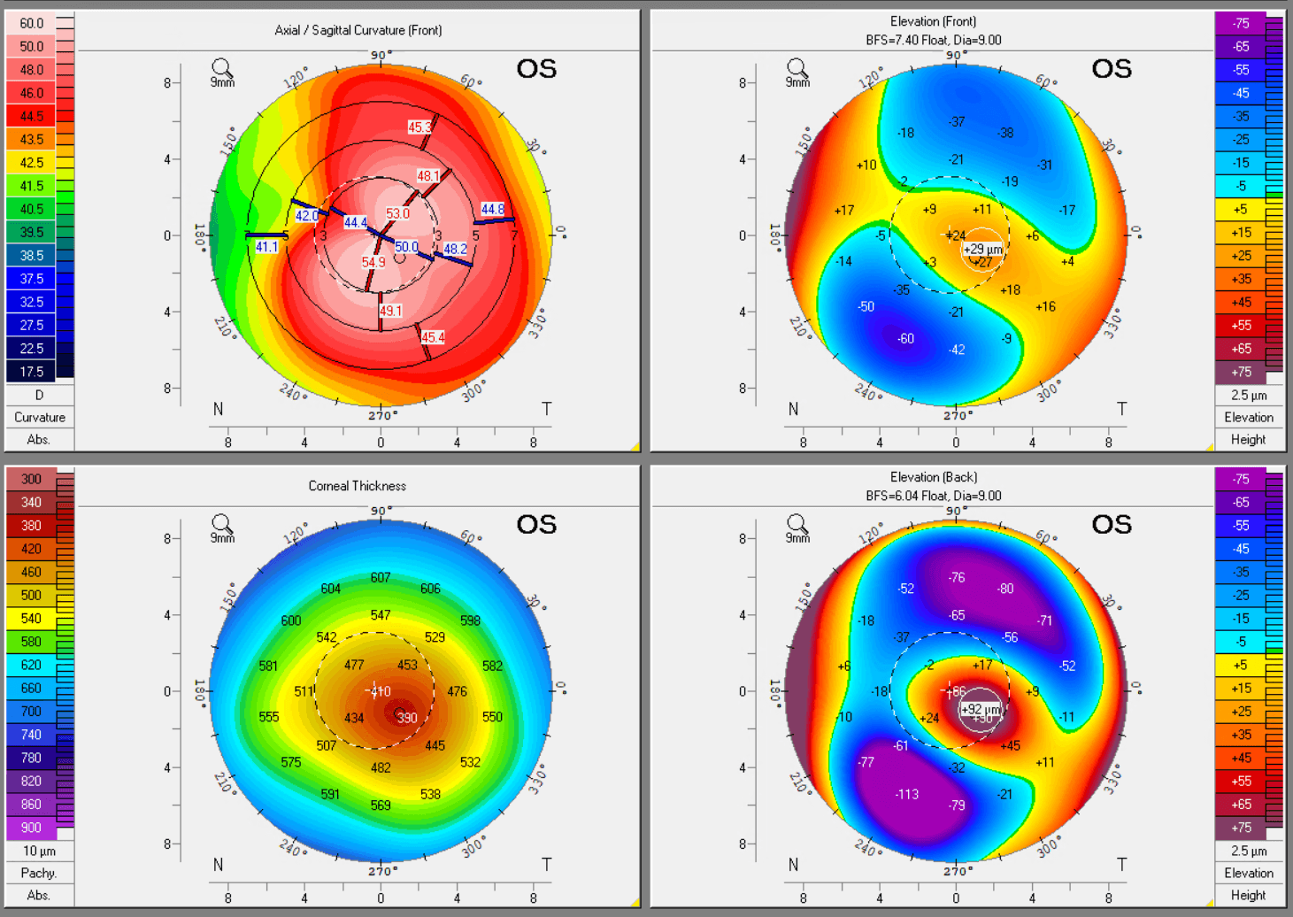 Pentacam corneal tomography maps used for keratoconus diagnosis
