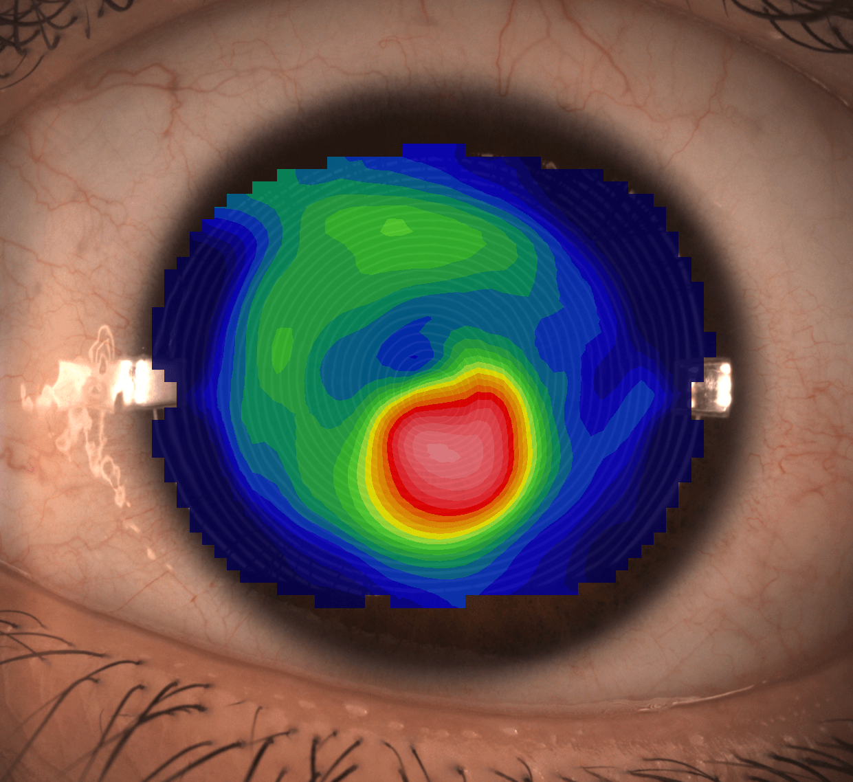 Corneal topography map showing keratoconus on the eye