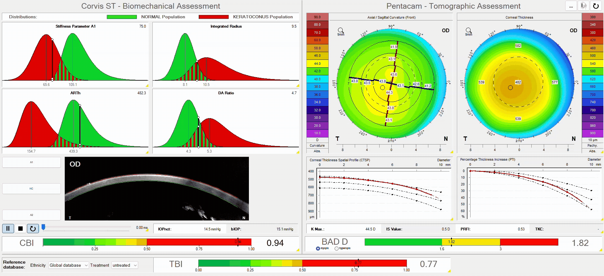 Pentacam and Corvis ST assessment for keratoconus diagnosis and monitoring