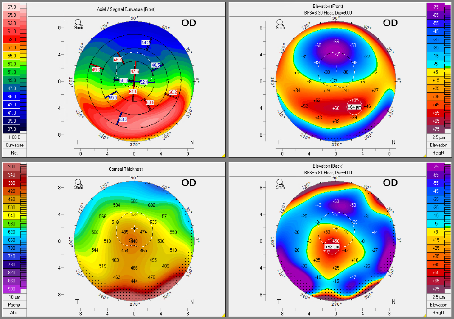 Corneal tomography showing PMD with steepening and thinning
