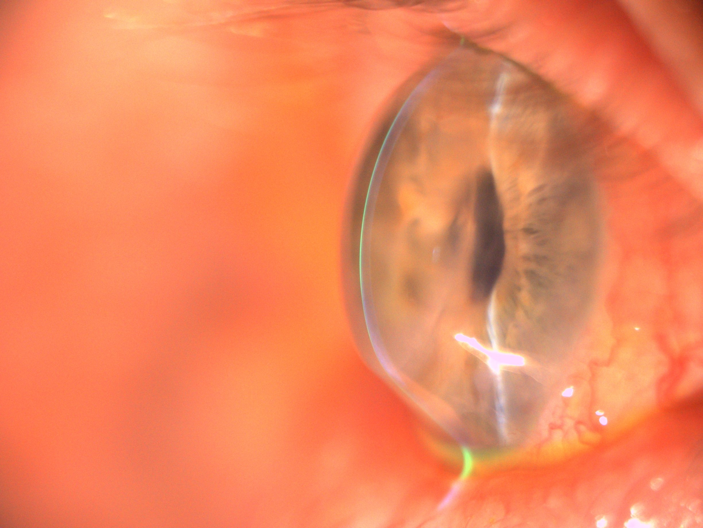 Side view of corneal graft after keratoconus surgery