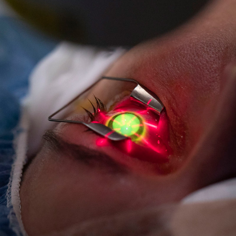 Corneal cross-linking treatment for keratoconus