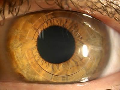 INTACS corneal ring segments for keratoconus treatment