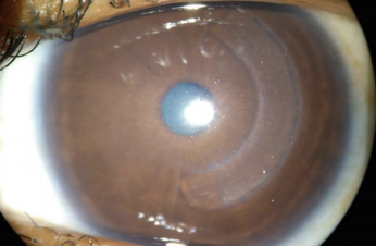 CAIRS corneal ring segment for keratoconus treatment