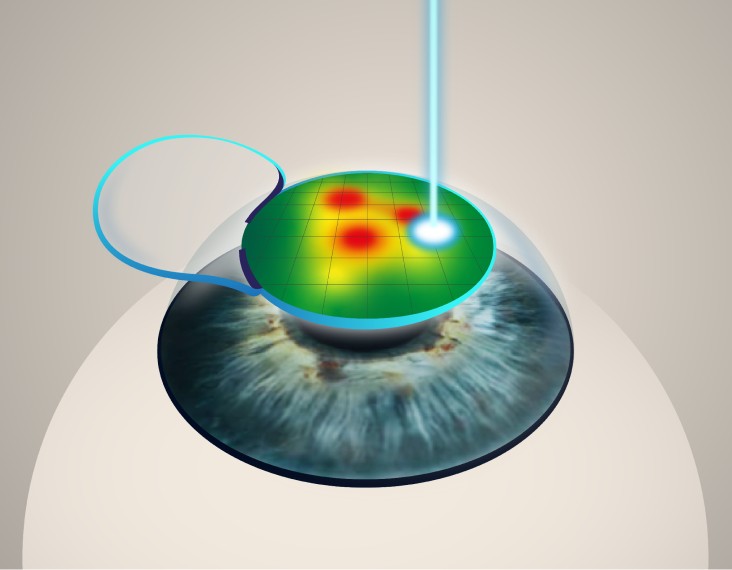 Topography-guided PRK treatment map for keratoconus