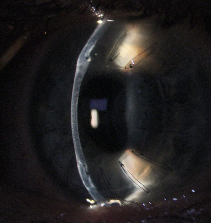 Corneal graft with sutures after keratoconus surgery