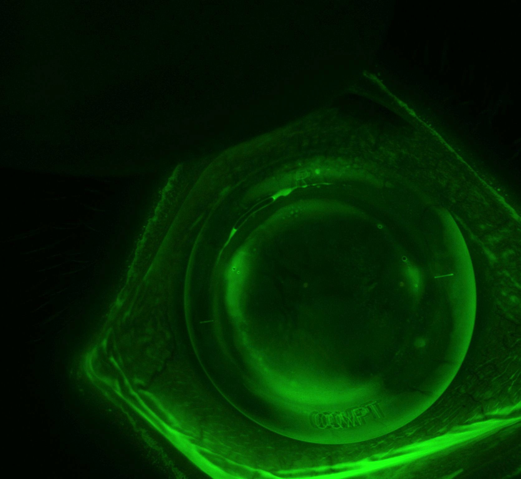Scleral lens assessment with fluorescein after keratoconus surgery