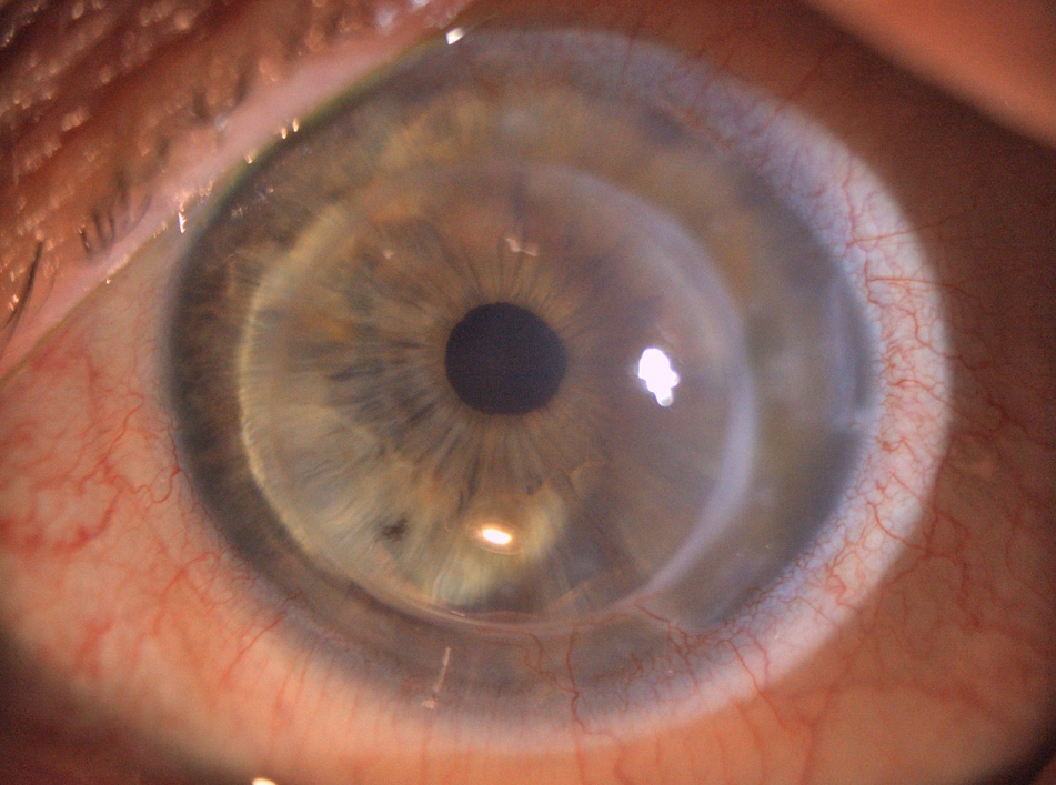 Front view of corneal graft after keratoconus surgery