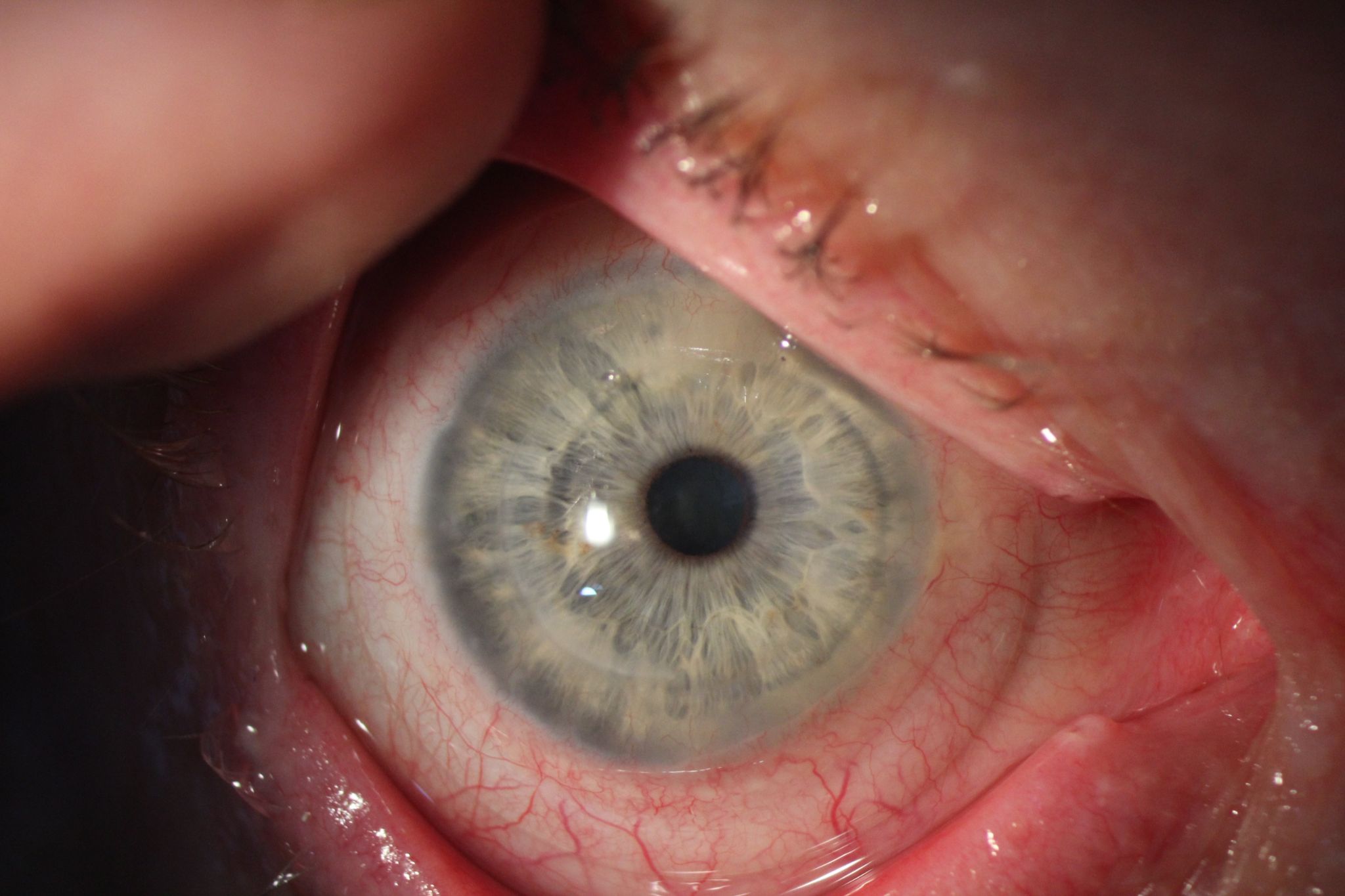 Scleral lens fitted over corneal graft after keratoconus surgery