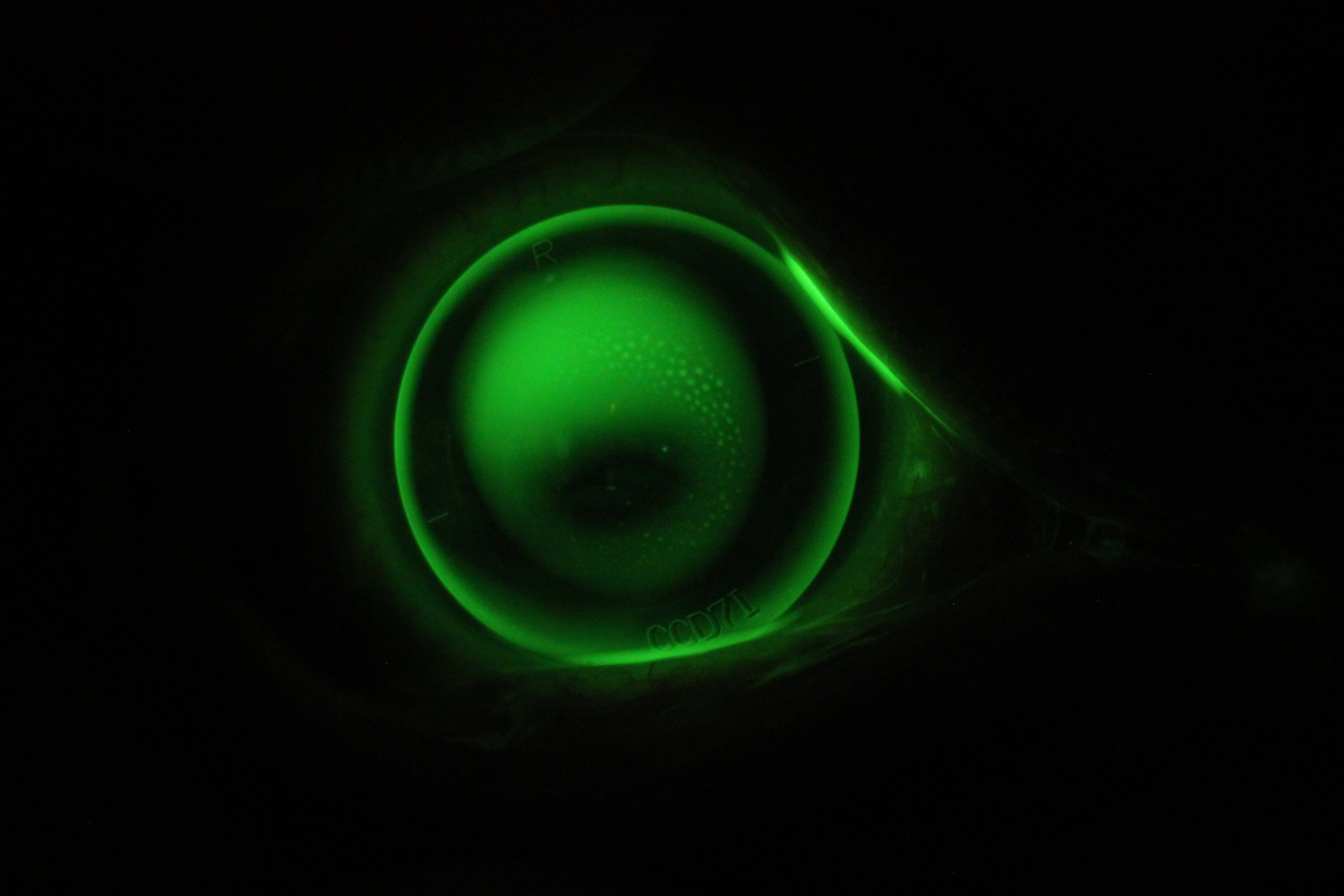 Corneal rigid contact lens for keratoconus