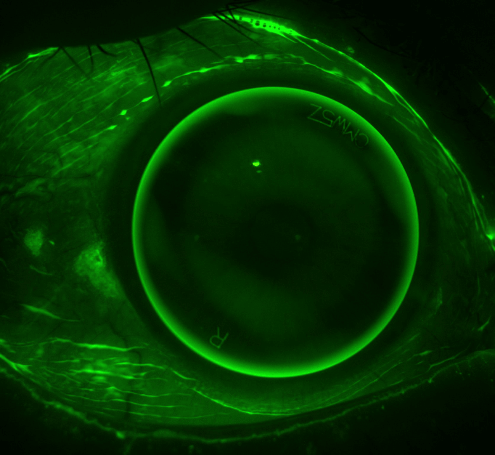 Rigid contact lens on the eye assessed with fluorescein