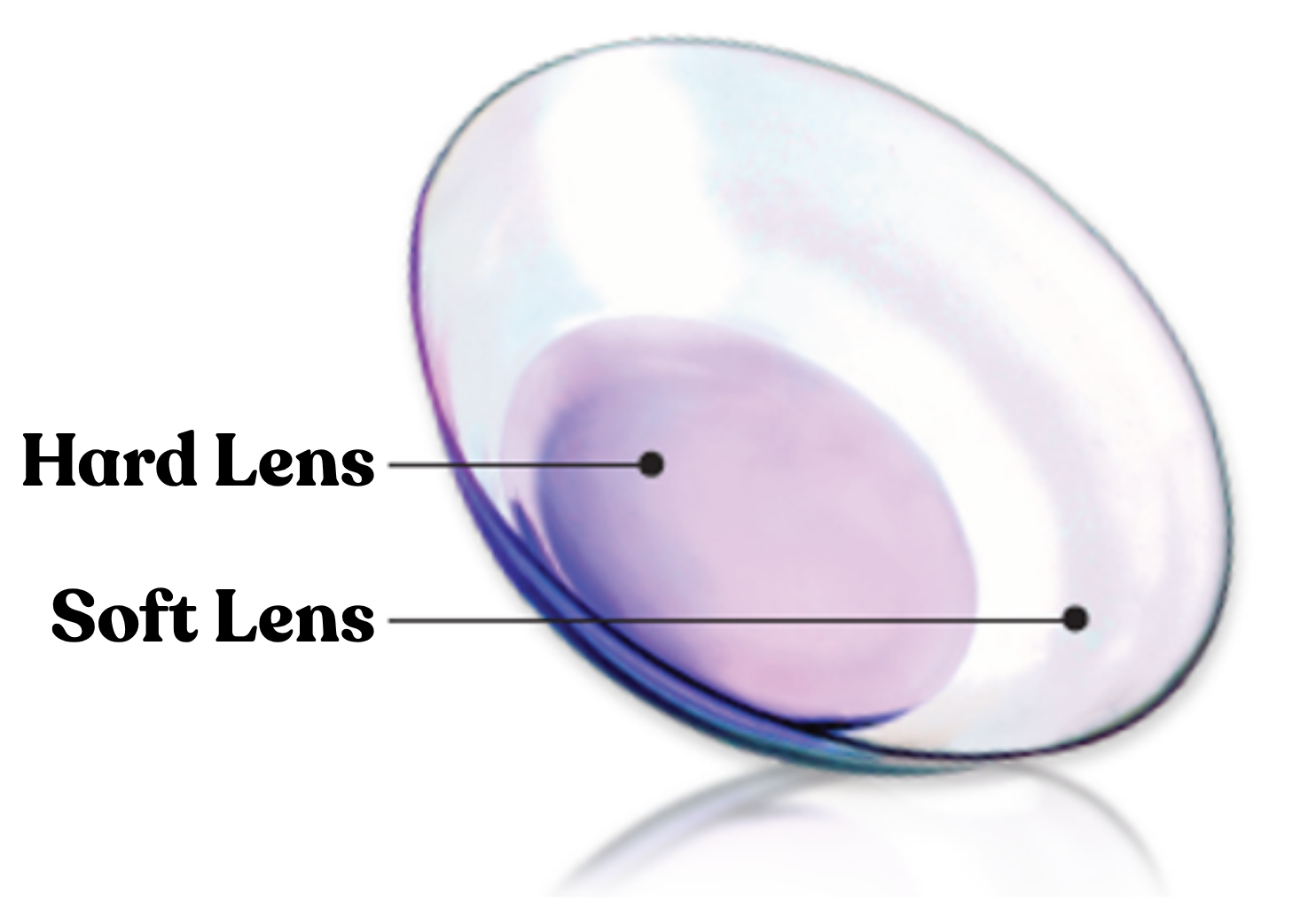 Hybrid contact lens diagram showing hard centre and soft skirt
