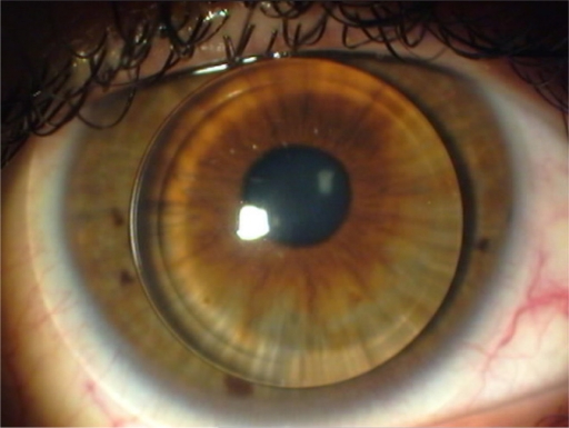 Piggyback contact lens system for keratoconus