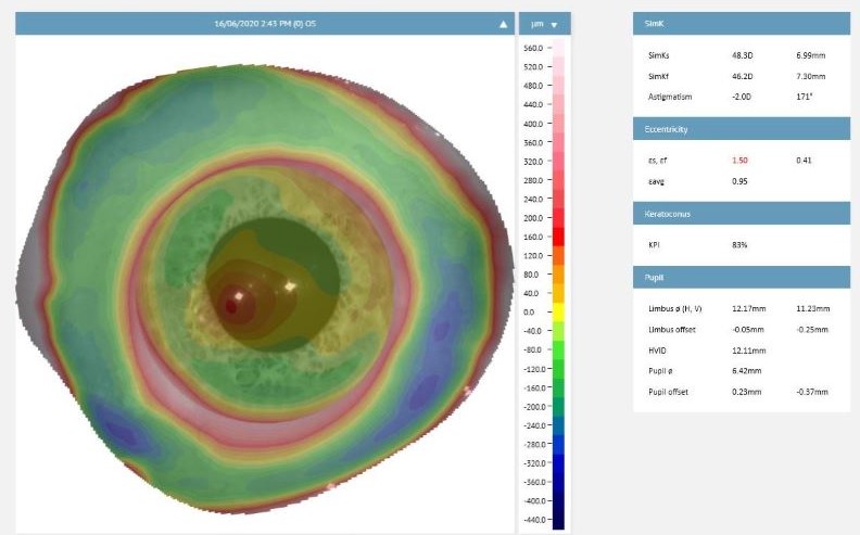 Corneo-scleral profilometry scan used to design a custom scleral lens for keratoconus