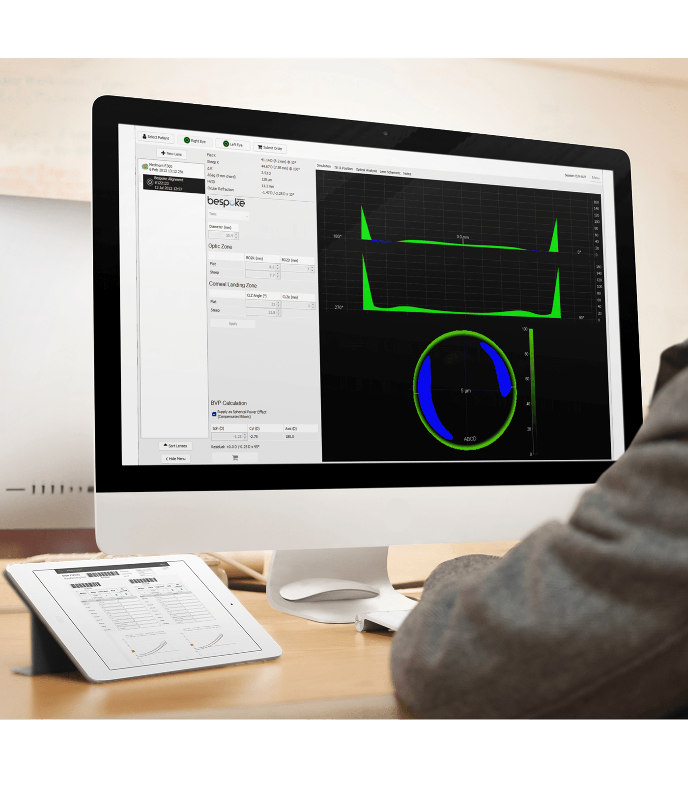 EyeSpace software used to design custom RGP contact lenses for keratoconus