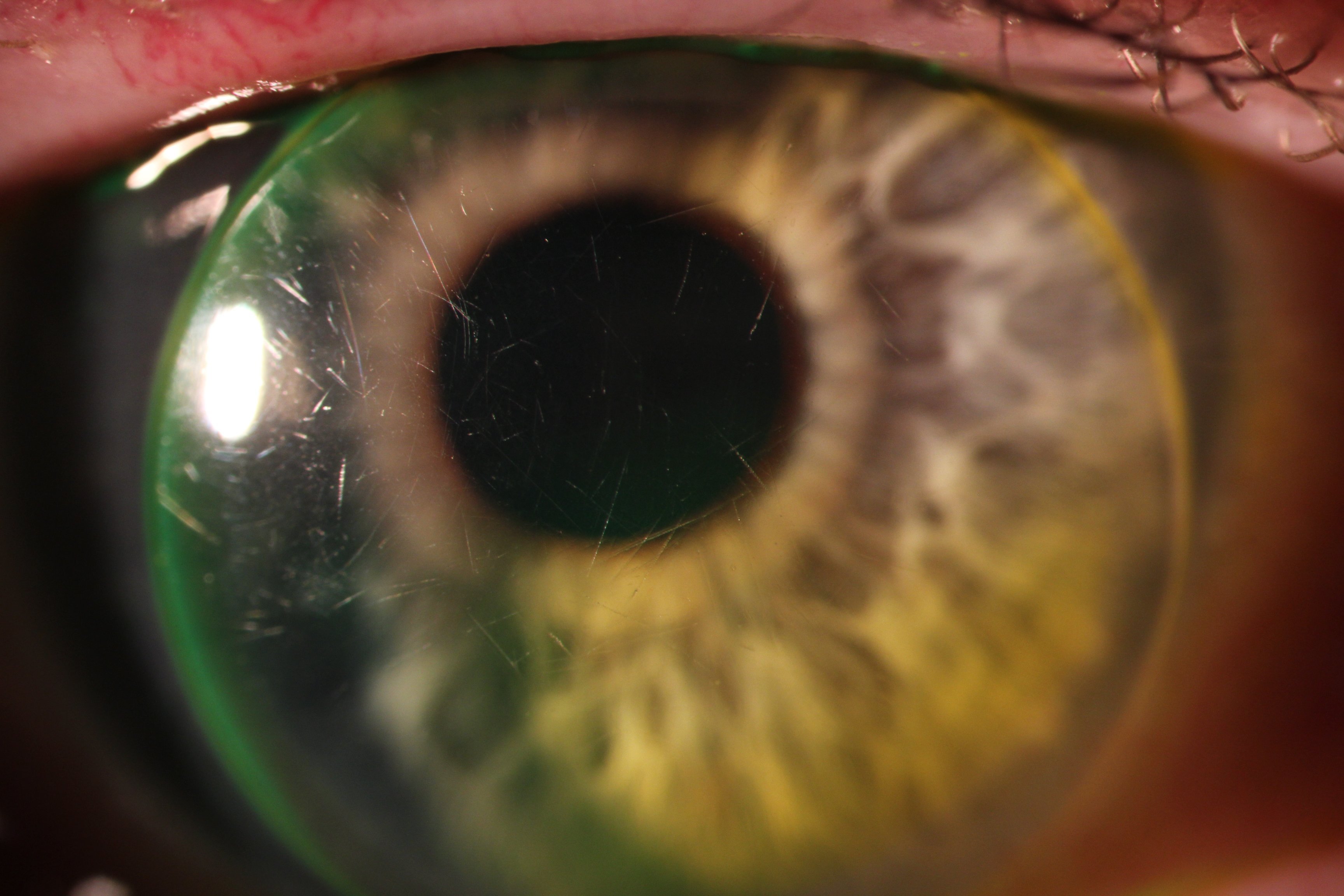 Scratched contact lens surface affecting comfort and vision
