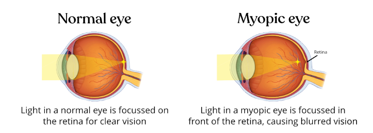 Diagram comparing light focus in a normal eye and a myopic eye